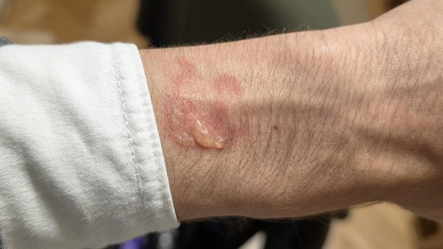 Vết đỏ và bóng nước trên cổ tay được cho là xuất hiện dưới Galaxy Watch 5 Pro