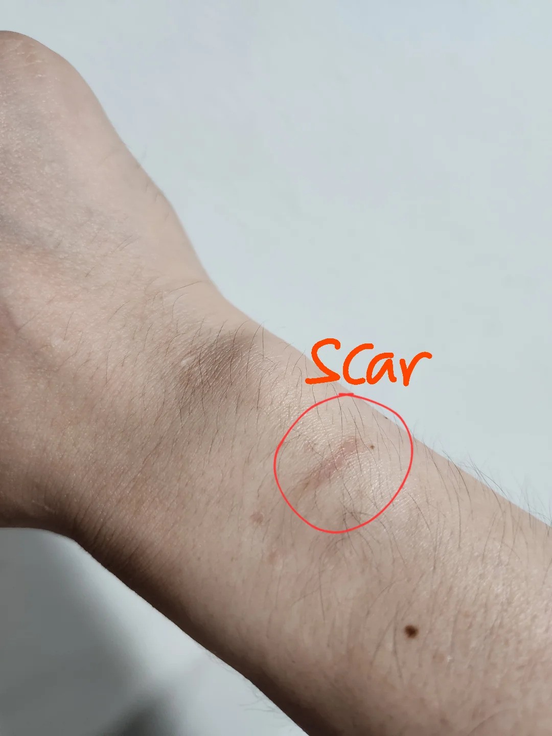 Vết sẹo được người dùng khoanh trên cổ tay sau khi đeo Galaxy Watch 8
